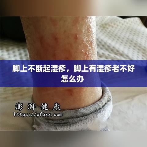 腳上不斷起濕疹，腳上有濕疹老不好怎么辦 