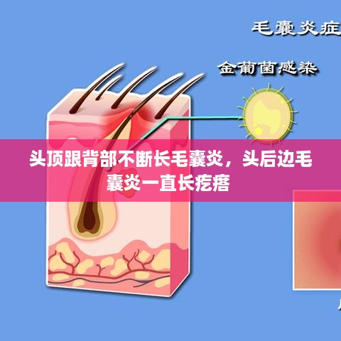 頭頂跟背部不斷長毛囊炎，頭后邊毛囊炎一直長疙瘩 